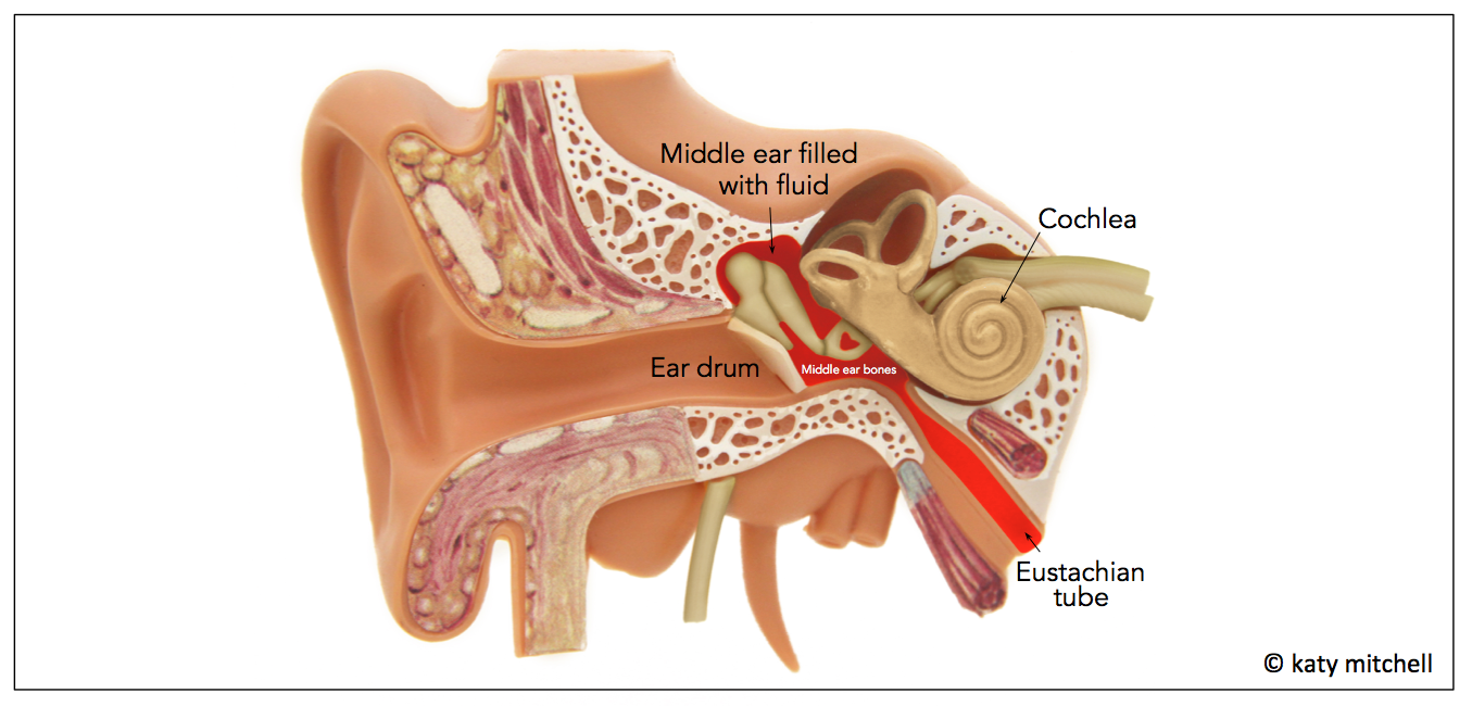 Middle ear fluid picture MESHGuides
